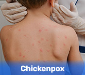 Chickenpox