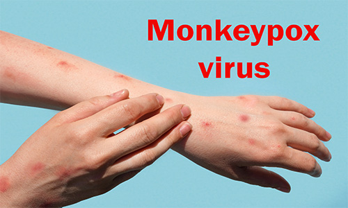 Travelling Amid Monkeypox Outbreak